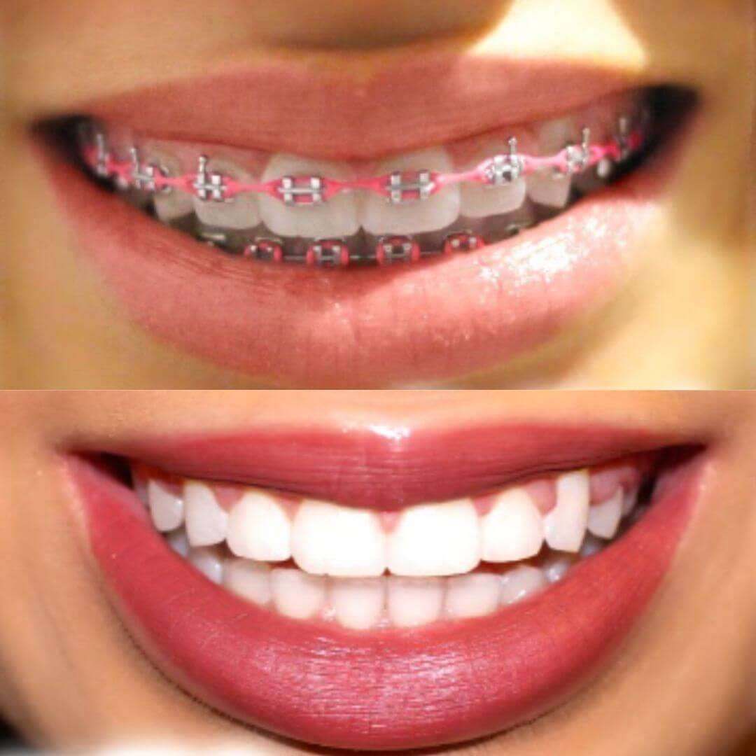 Braces Before and After