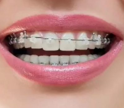 Ceramic Braces