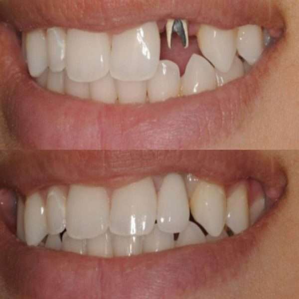 Dental Implants