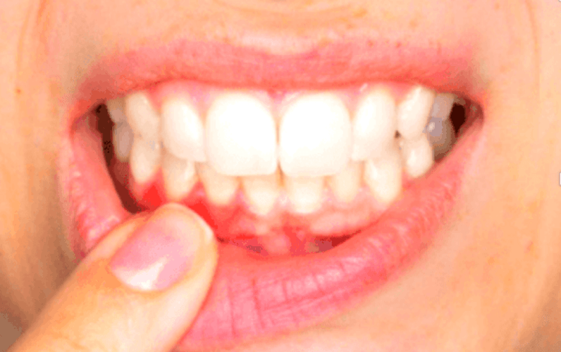 Gingivitis Treatment in Dubai