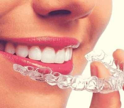 Invisalign Braces
