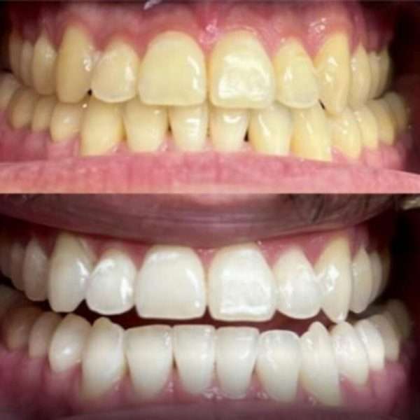 best teeth whitening in Dubai