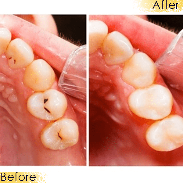 tooth filling cost Dubai
