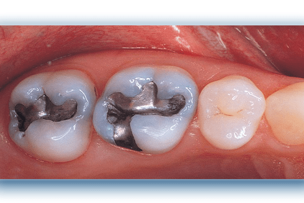 composite filling