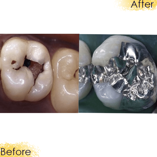dental filling in Dubai dental filling in Dubai