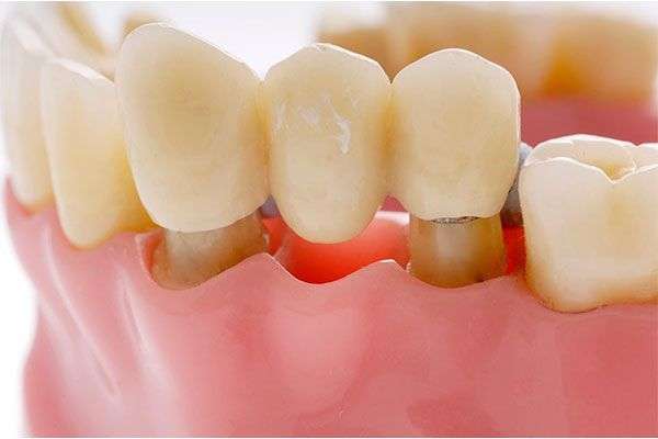 Dental Bridges in Dubai