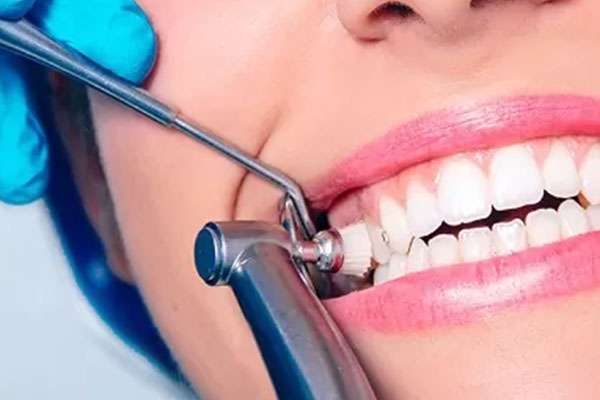 Teeth Scaling & Polishing in Dubai