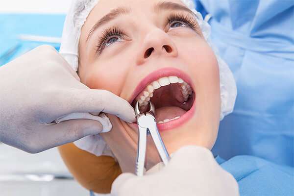 Wisdom Tooth Removal in Dubai