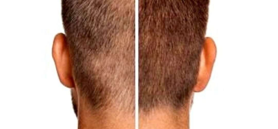 Hair Loss Treatment at Ferdows