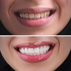 Hollywood Smile Hollywood Smile