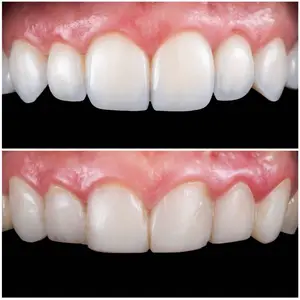Hollywood Smile2 Hollywood Smile Makeover