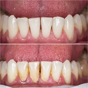 Hollywood smile4 Teeth cleaned on part of the hollywood smile